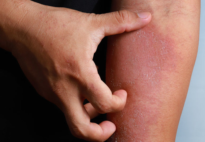 Sejumlah penyakit kulit yang kerap muncul pada wujud eksim basah